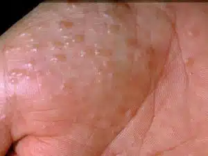 3529 Pompholyx Eczema Compressed 300x225 