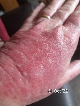 A red inflammation hand that is suffering from the skin condition eczema.