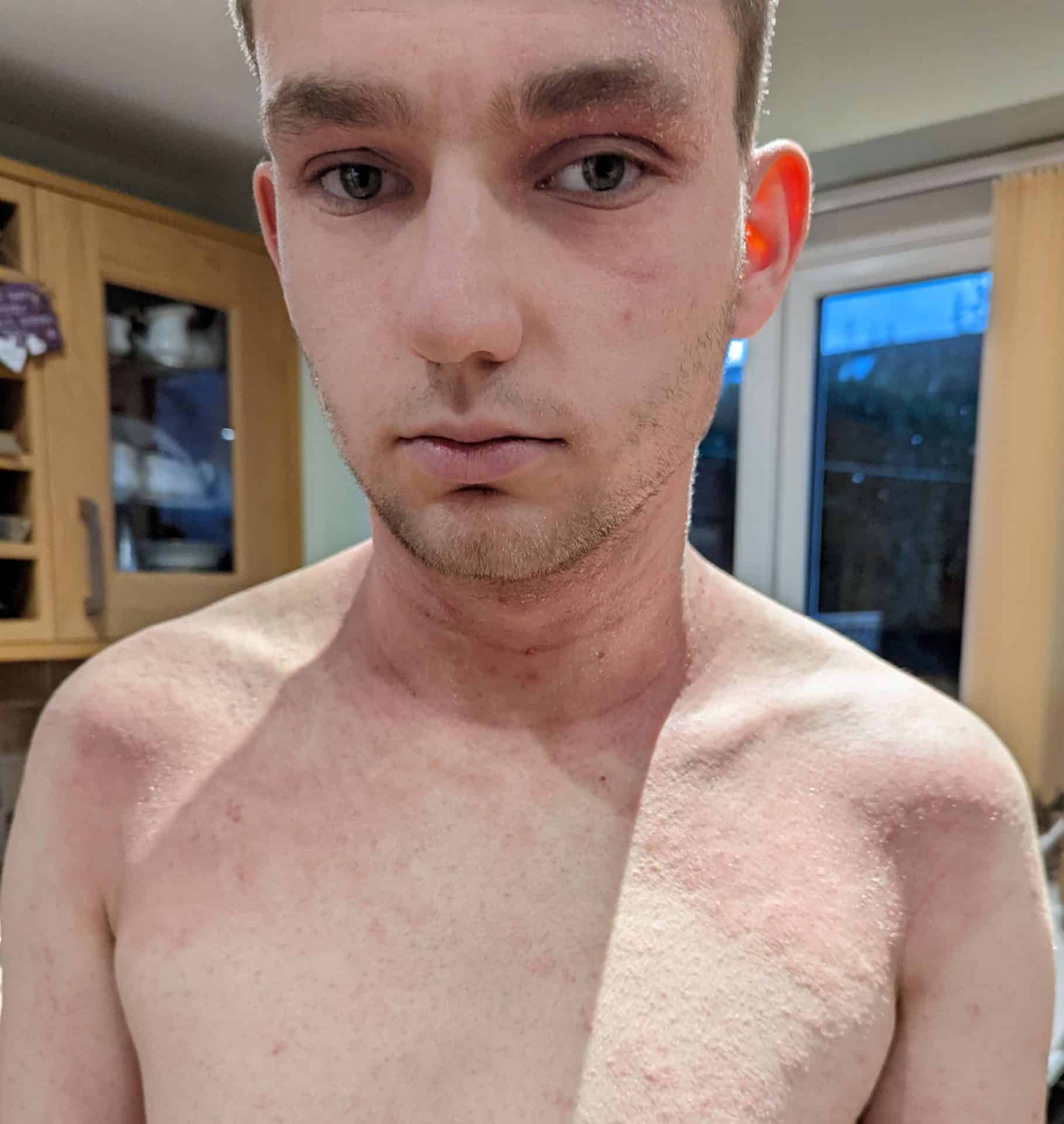 Callum's Eczema Story | National Eczema Society