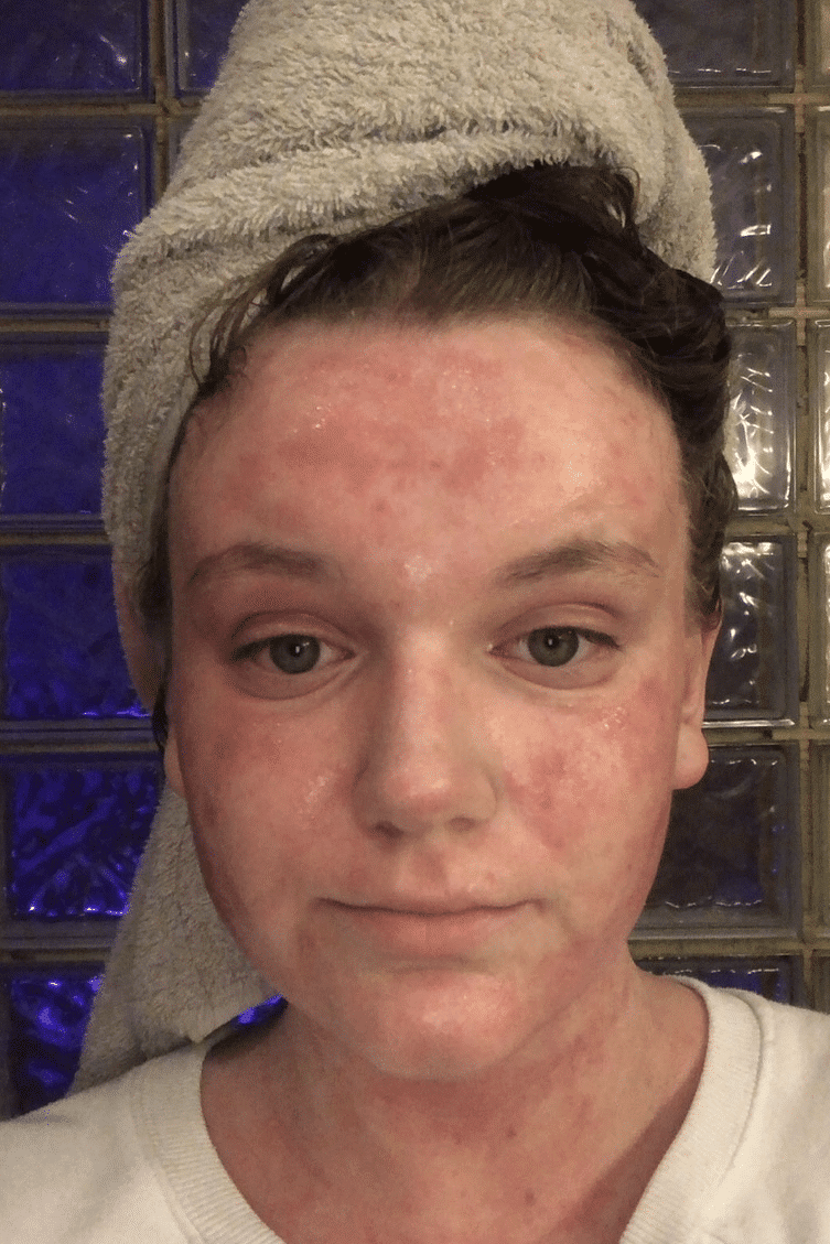 A young white women with a towel wrapped around her hair. On her face is a visible skin inflammation.