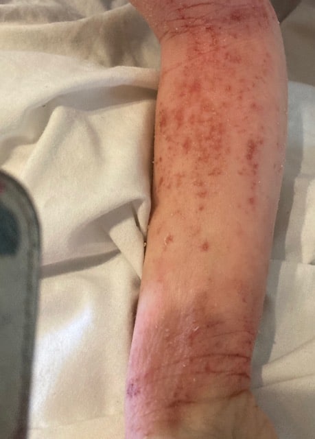 A close-up image of an arm with a visible inflamed skin and red patches - eczema