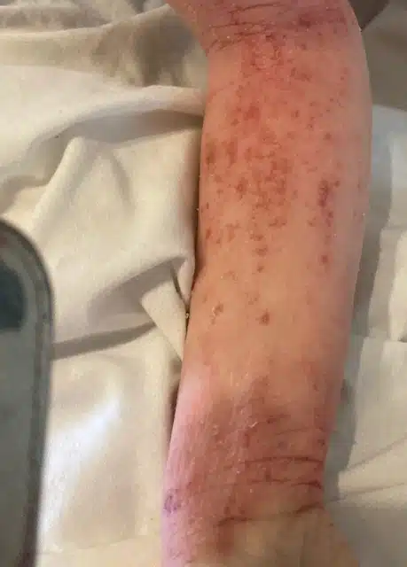 A close-up image of an arm with a visible inflamed skin and red patches - eczema