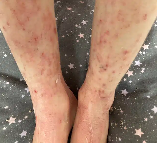 Close-up of a person's legs showing a inflamed skin (eczema), positioned against a background of fabric with star patterns.