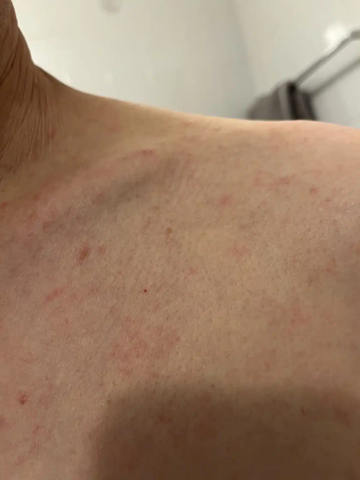 Red inflamed patches on the shoulder of a white person.