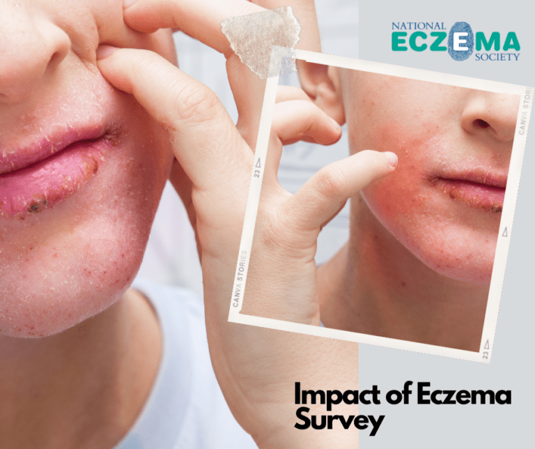 research for you eczema