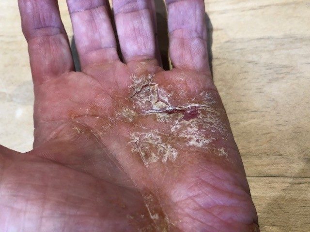 National Eczema Society
