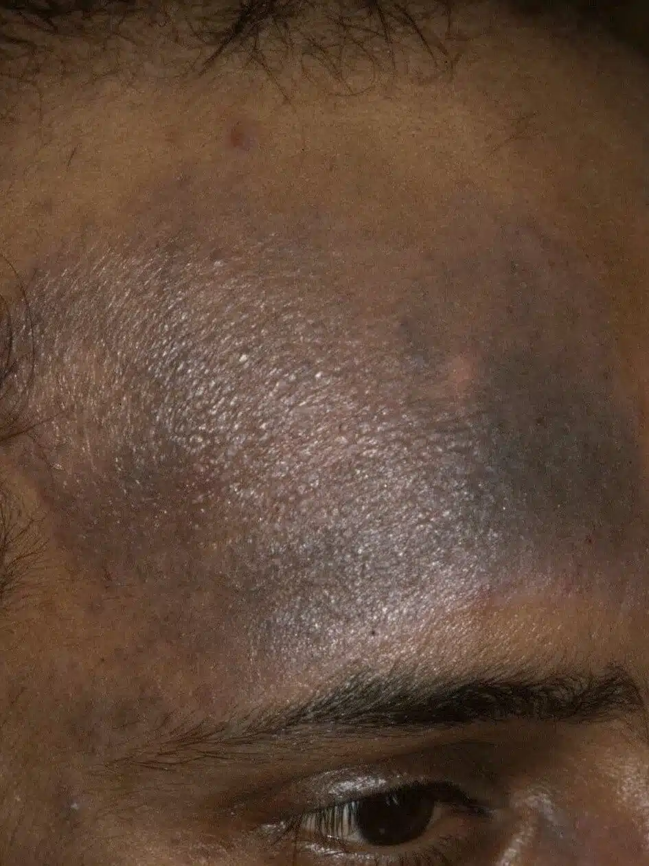 atopic dermatitis on face