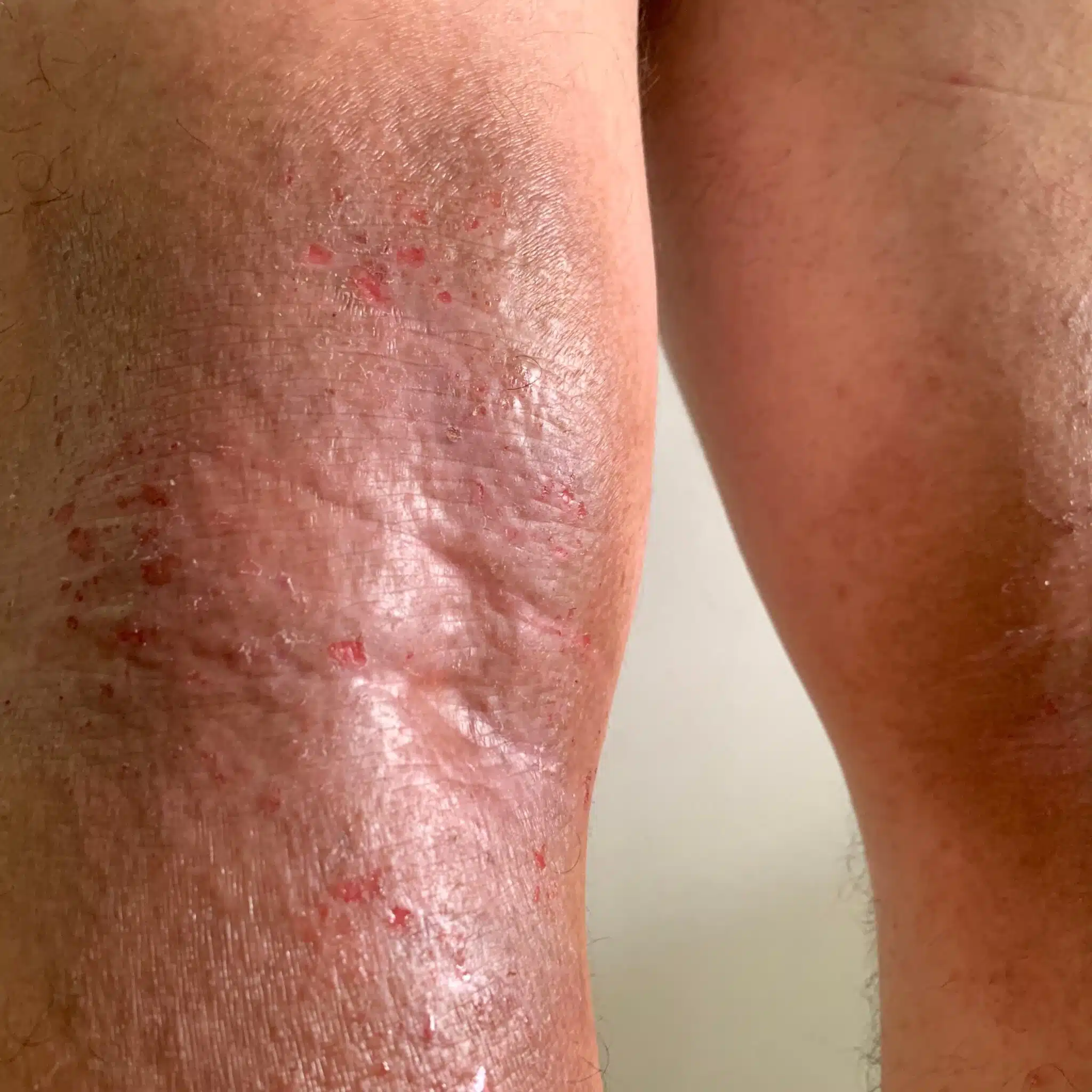 eczema bumps on elbows