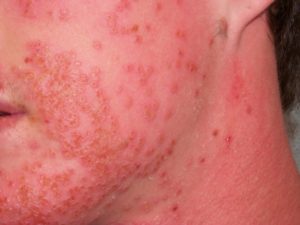 Infections and Eczema Society