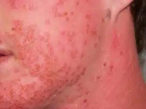 Is a skin yeast deals infection contagious