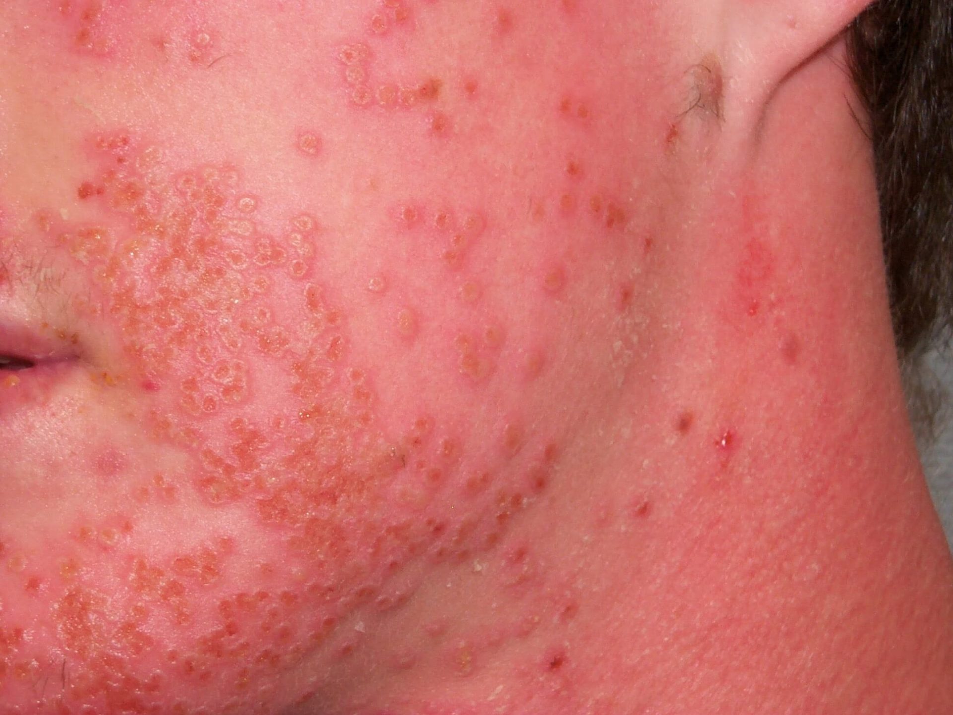 What is Septic Rash: The Hidden Dangers of Skin Infections