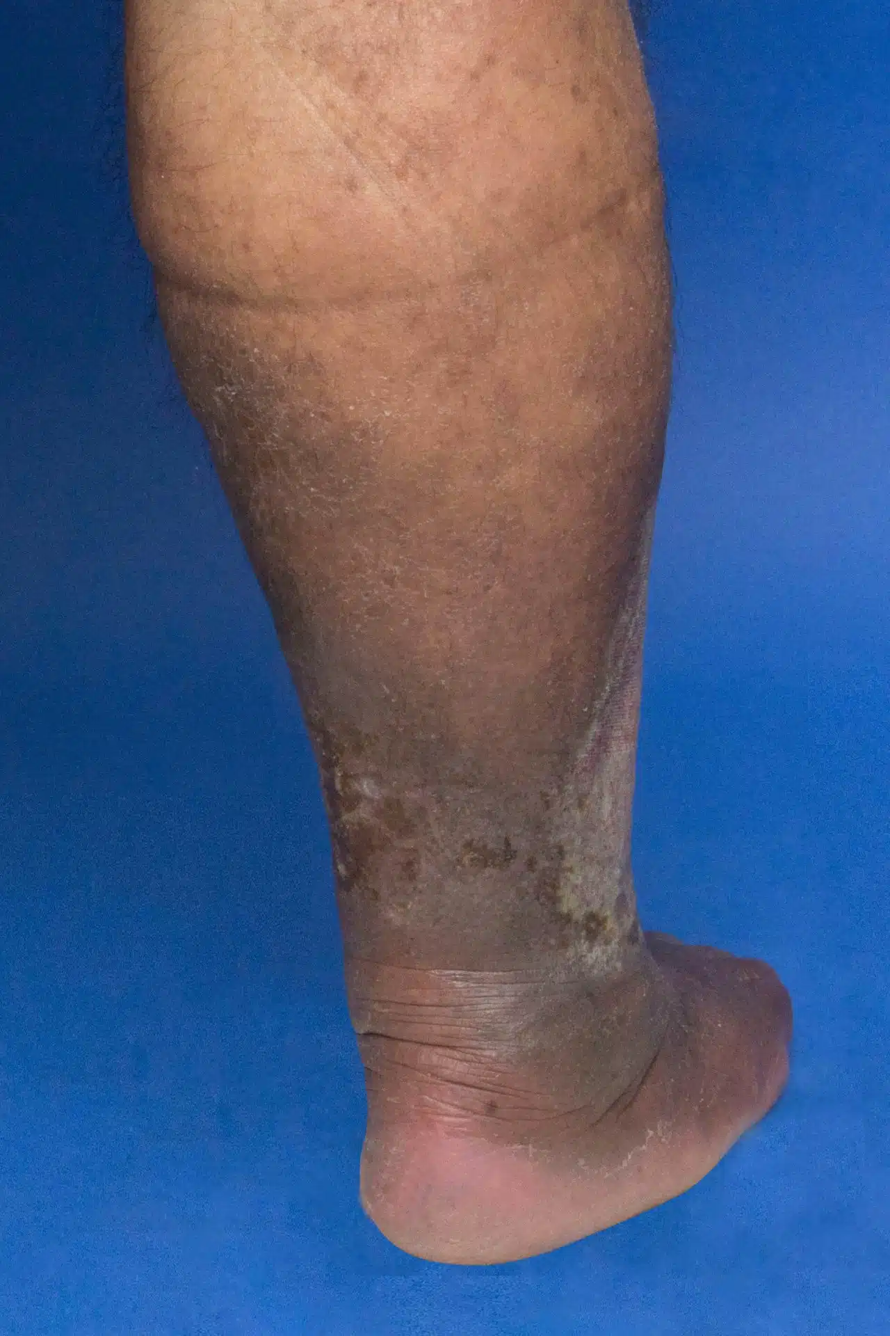 Lower Leg Discoloration: What Does It Mean?