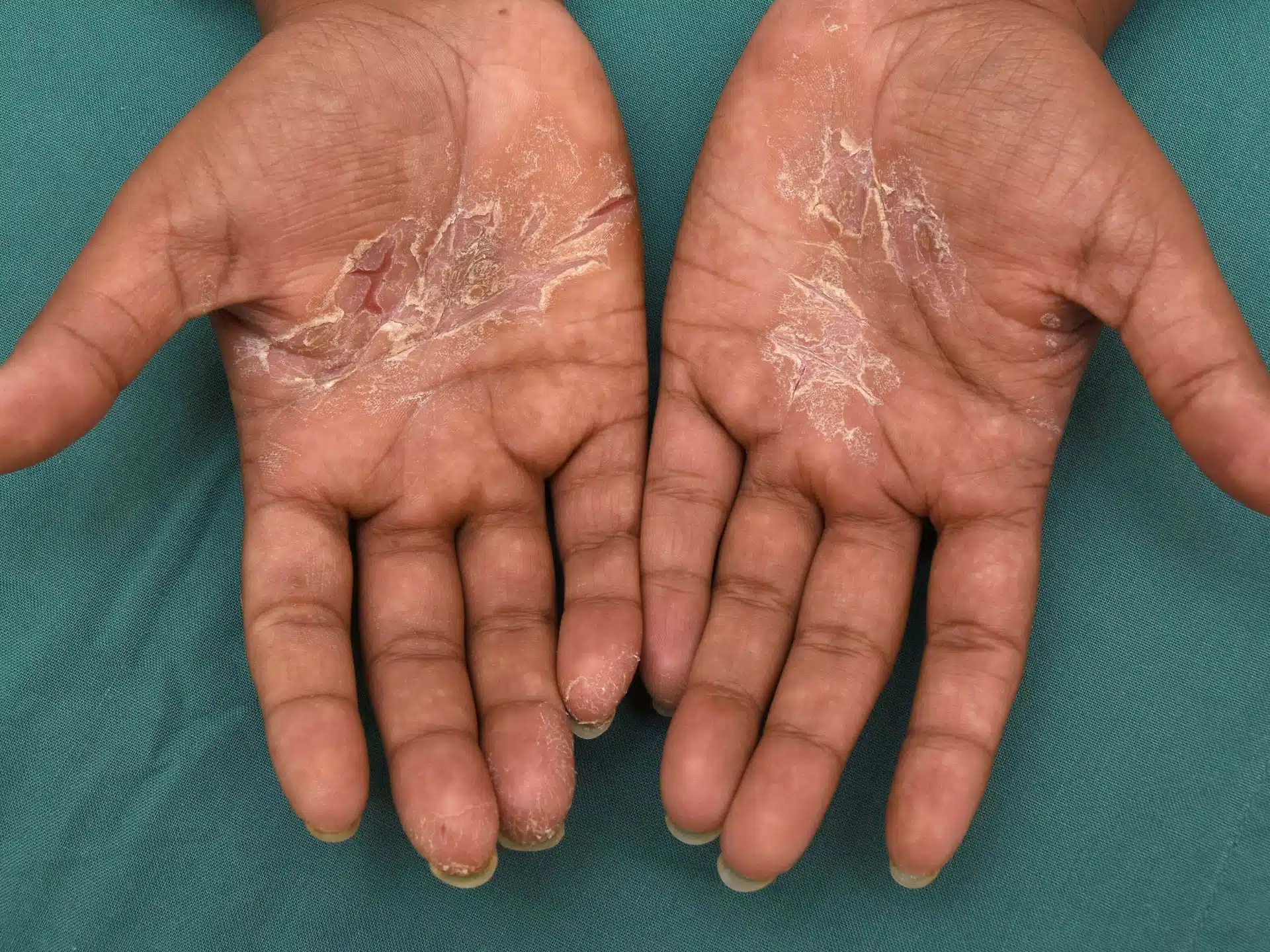 Hand Eczema About And Treatments