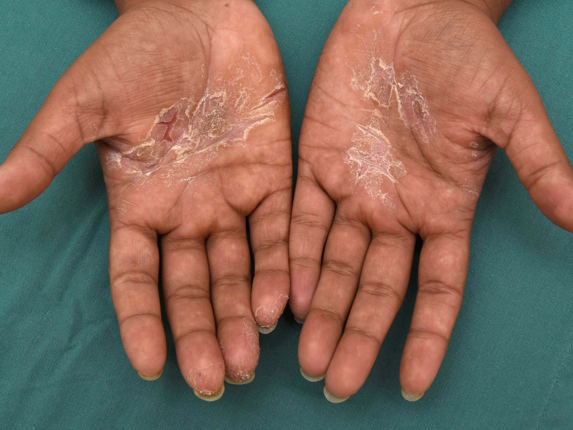 Dry Skin Patches On Hands And Feet