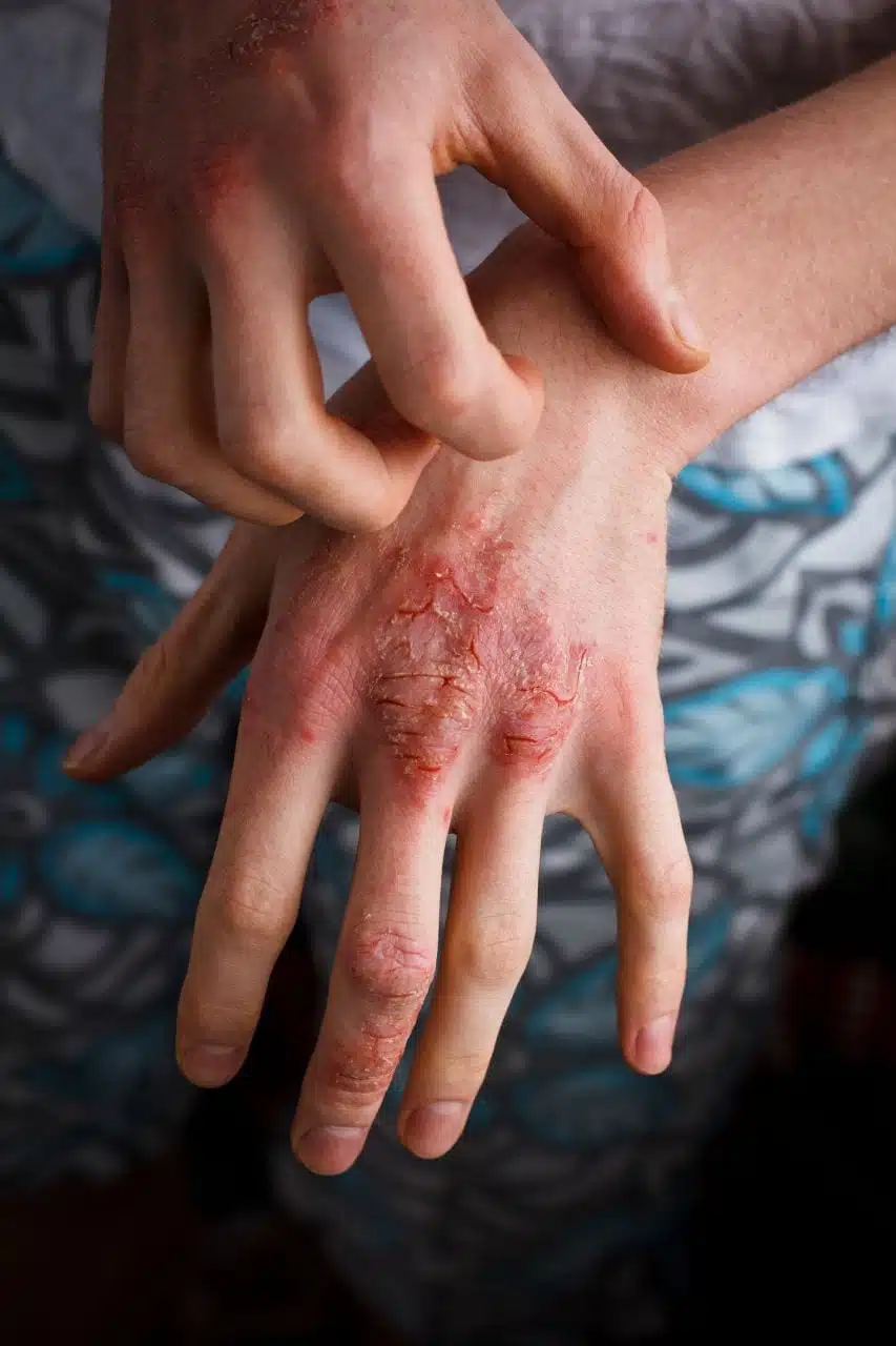 Person scratching hand eczema