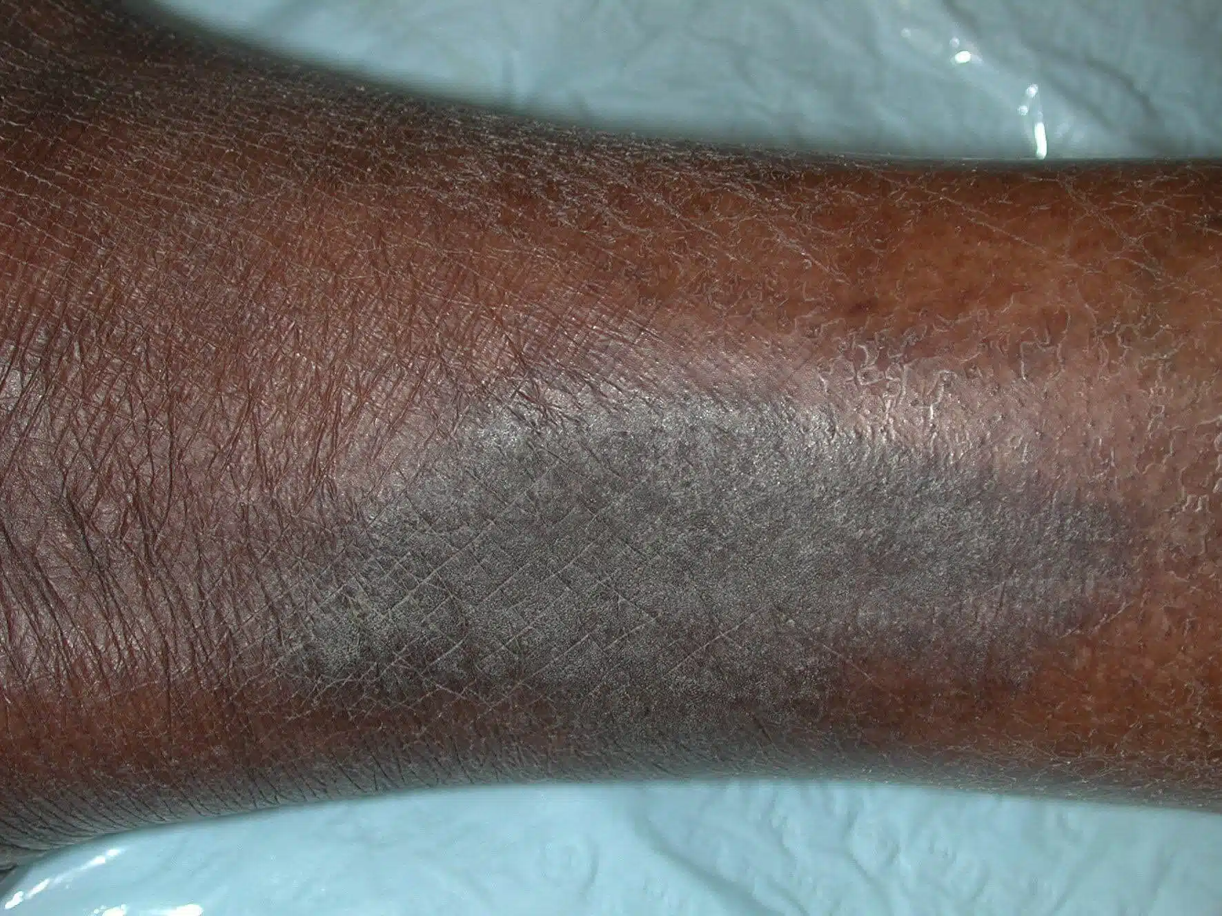 Eczema of legs on Black skin with erythema and lichenification