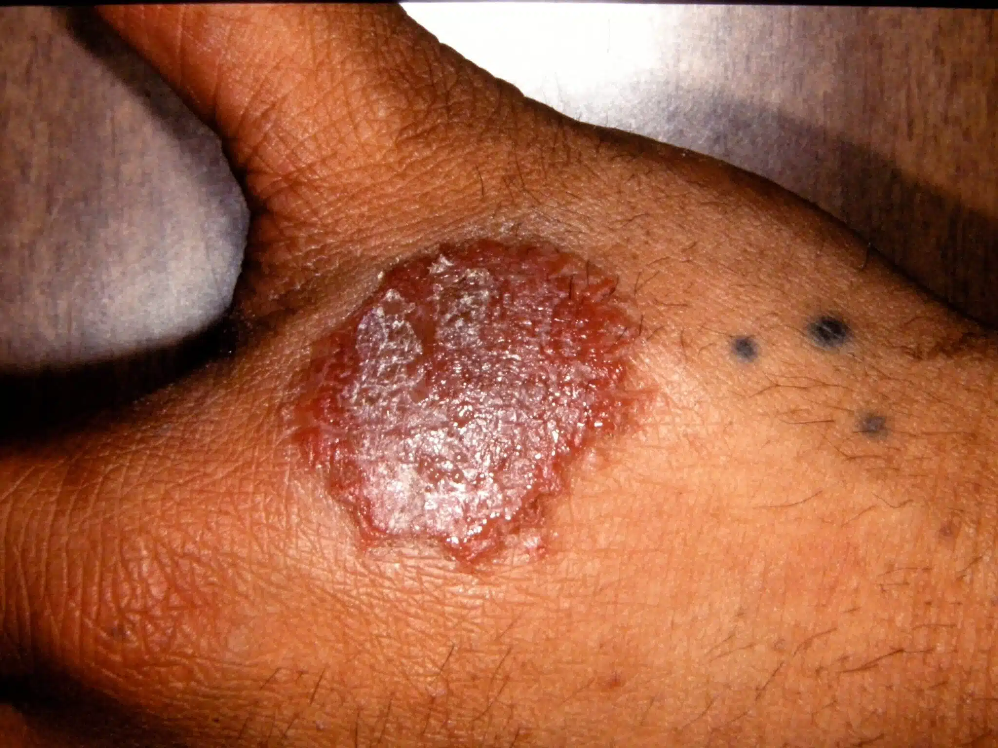 How do you explain this chronic, malodorous rash?
