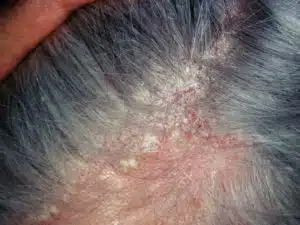 what causes seborrheic dermatitis face